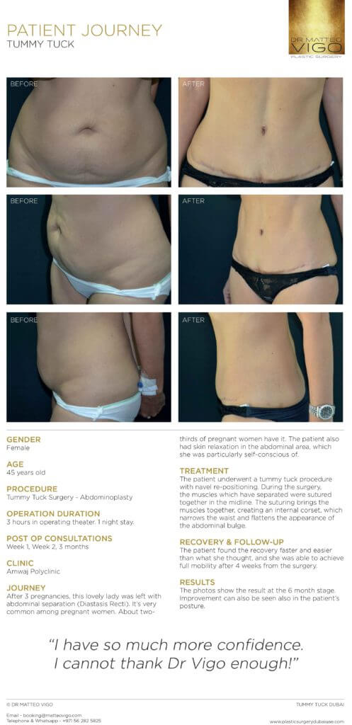 Tummy tuck