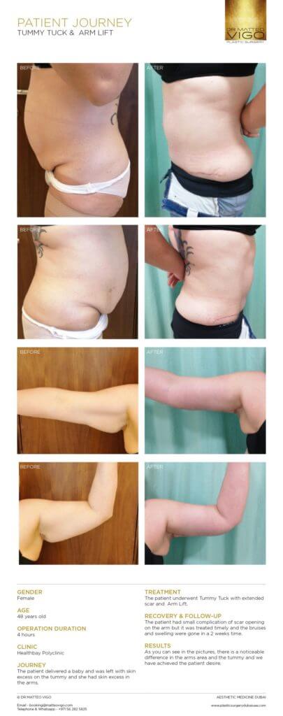 TUMMY TUCK & ARM LIFT